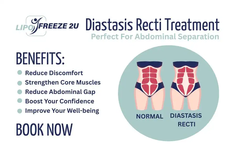 Benefits of body toning treatment Hereford for Diastasis recti