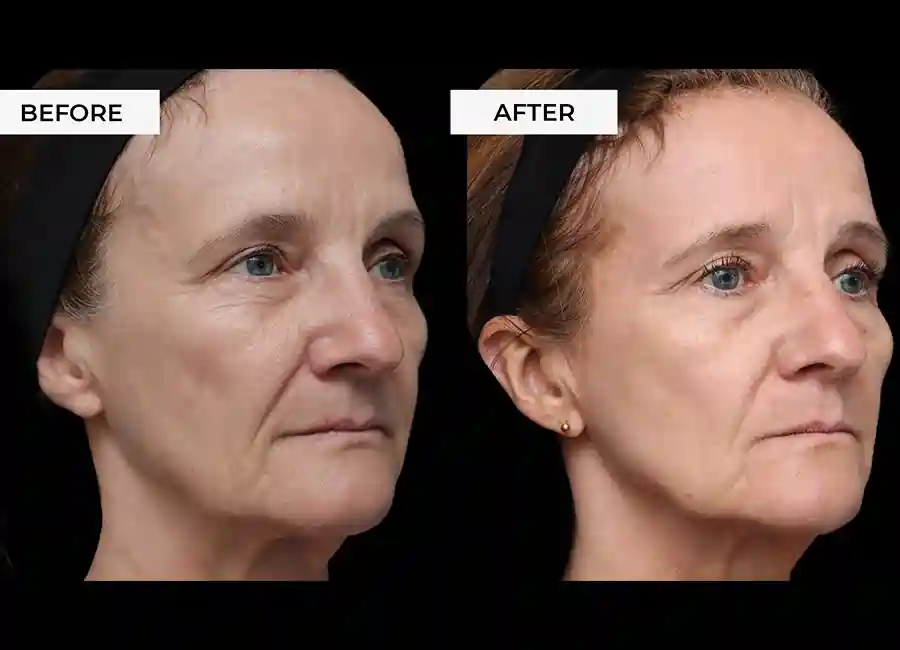 How Many RF Microneedling Sessions Will You Need to See a Difference Hereford?
