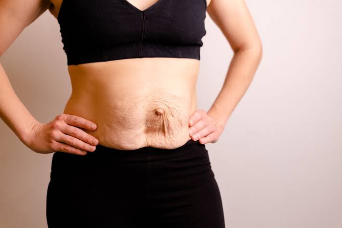 Is Surgery Really the Only Way to Repair Diastasis Recti Hereford?