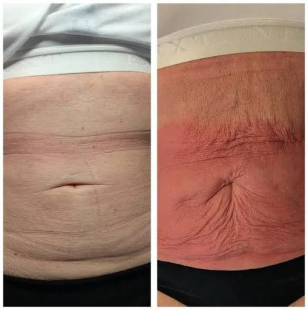 How Does RF Microneedling Improve Crepey, Thin and Uneven Skin Texture Hereford?