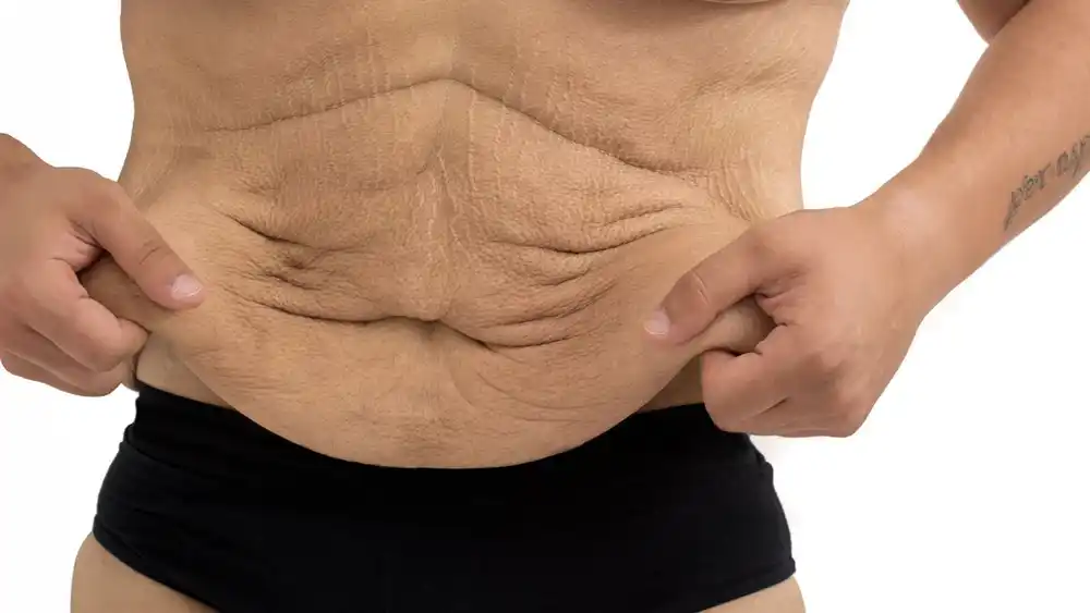 Why Does Weight Loss Medication Leave Some People With Loose or Sagging Skin Hereford?